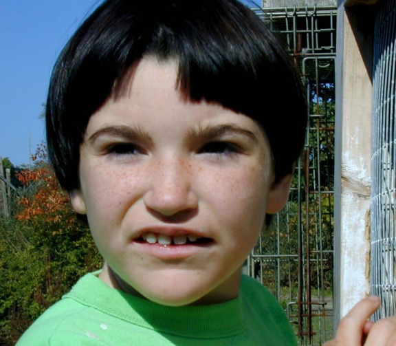Figure 4. . Girl age ten years with Pitt-Hopkins syndrome.