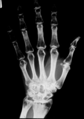 Figure 1. . A radiograph of the hand of a person with PLOSL demonstrates multiple cyst-like lesions and loss of bone trabeculae.