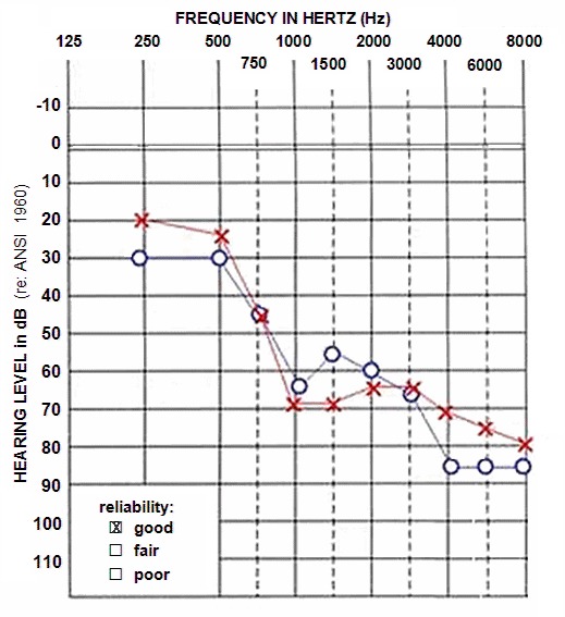 Figure 1. . Audiogram from an individual age 12 years with DFNA2 hearing loss.