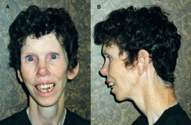 Figure 4. . Adults typically have a long face and neck, accentuated by sloping shoulders, resulting in a gaunt appearance, as seen in this affected individual, age 43 years.