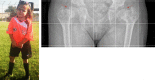 Figure 6. . Girl age five years with nonclassic RCDP1 showing better growth than classic RCDP1 and absence of rhizomelia.