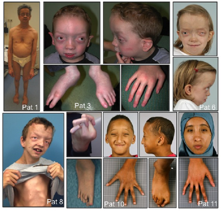 Figure 1. . Clinical features of Shprintzen-Goldberg syndrome.