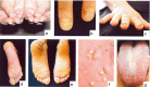 Figure 1. . Common findings of pachyonychia congenita include: thickened and dystrophic nails (both fingernails and toenails) (a-c); bullae (usually on the pressure points of the heels and soles); hyperkeratosis (d-e); cysts (f); and oral leukokeratosis (g).