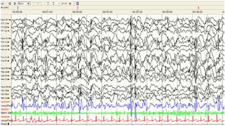 Figure 2. . Individuals with Dravet syndrome often have an unusual seizure type that frequently will manifest as obtundation status epilepticus.