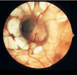 Figure 1. . Classic lacunae surround the modestly dysplastic left optic disc.