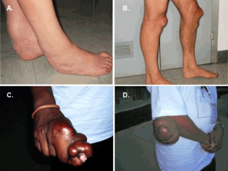 Figure 1. . Different localization and severity of tendon xanthomas in CTX.