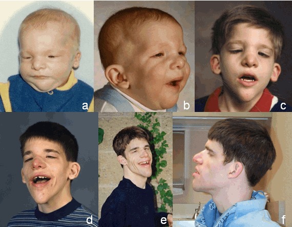 Figure 1. . An individual with Mowat-Wilson syndrome at (a) one month, (b) two months, (c) five years, (d) 13 years, (e) 20 years, and (f) 21 years.