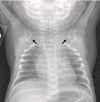 Figure 2. . Chest x-ray demonstrates clavicular hypoplasia.