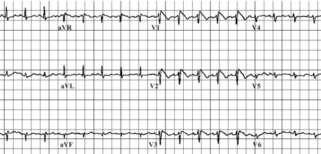 Figure 1. . Characteristic EKG in Brugada syndrome.