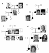 Figure 1. . Intrafamilial variation in families with a confirmed TCOF1 pathogenic variant.