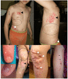 Figure 1. . Ectodermal manifestations include yellowish-pink areas representing fat herniation (white arrowheads), patchy aplasia (black arrowheads), hyper- & hypopigmentation following lines of Blaschko (black arrows indicating the border), and hypopigmented areas of poikiloderma (circled regions).