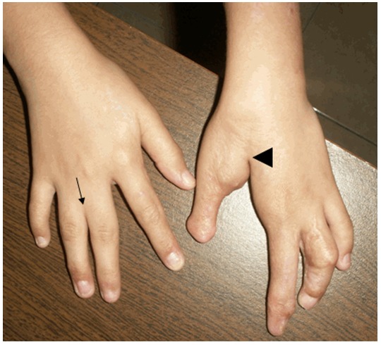 Figure 2. . Hands showing syndactyly (black arrow) and split-hand malformation (black arrowhead) with only four digits (oligodactyly) on the left hand.