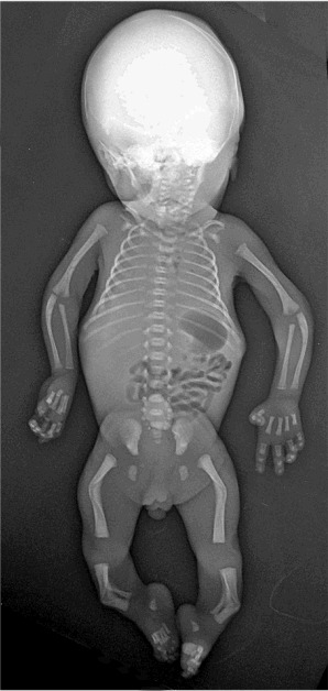 Figure 3. . Classic radiographic features of campomelic dysplasia in a 24-week fetus.