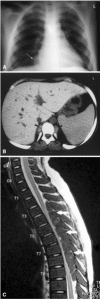 Figure 11-1:. Representative images of paraspinal extramedullary hematopoietic pseudotumors. (A) Chest X-ray demonstrating expanded anterior rib ends consistent with medullary hyperplasia. A paraspinal mass is seen in the right lower zone (white arrow). (B) Computed tomography scan showing inactive paraspinal extramedullary hematopoietic lesion with increased density compared to soft tissue due to iron deposition (black arrowheads). (C) Magnetic resonance image of cervical and thoracic spine. T2-weighted sagittal image showing thoracic cord compression by extramedullary intraspinal epidural hematopoietic mass from T2 to T10 (white arrows). Reproduced with permission from reference [10].