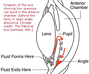 Image glaucoma.jpg