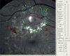 FIGURE 3. Screenshot of software used to annotate features on the retinal photographs.