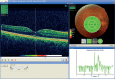 FIGURE. Topcon example 2 showing an excessive reposition of the Early Treatment Diabetic Retinopathy Study grid.