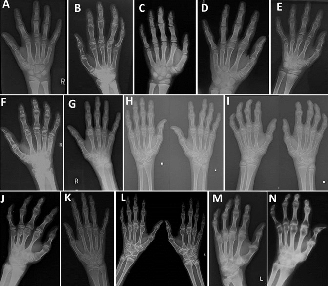 Figure 2. . Radiographs of hands showing large epiphyses and widened metaphyses of metacarpals and phalanges.