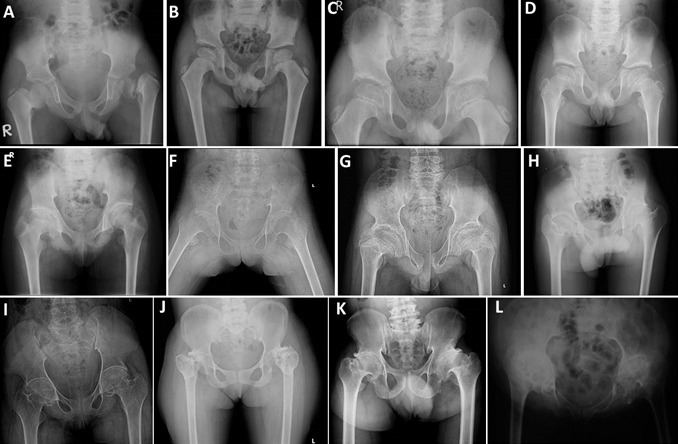 Figure 3. . Pelvic radiographs demonstrating reduced hip joint spaces, large capital femoral epiphyses, short and broad femoral necks, and irregular acetabular roofs.