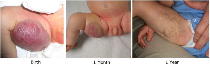 Photographs showing a cutaneous congenital hemangioma on the inner right thigh at birth (left panel), 1 month (middle panel), and 1 year (right panel).