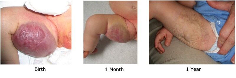 Photographs showing a cutaneous congenital hemangioma on the inner right thigh at birth (left panel), 1 month (middle panel), and 1 year (right panel).