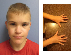 Figure 3. . Male with Myhre syndrome at age 12 years with mild facial features (mild maxillary underdevelopment and thin vermilion of the upper lip) and finger contractures.