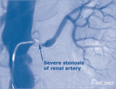 Arteriogram Showing Renal Artery Stenosis.