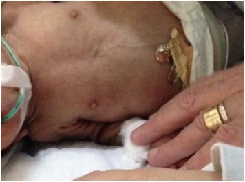 Figure 3. . Prominent nipples are a typical finding in neonates with Donohue syndrome.