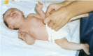 Figure 3. . Infant with Crisponi syndrome, caused by CLCF1 biallelic pathogenic variants, demonstrating the tendencies to grimace and startle while being handled.