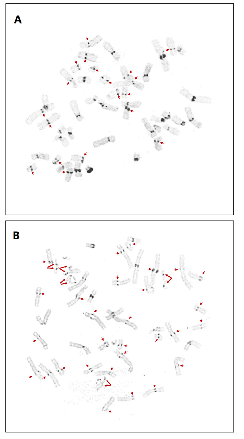 Figure 1. . C-banding of metaphase chromosomes in two individuals with Warsaw syndrome.