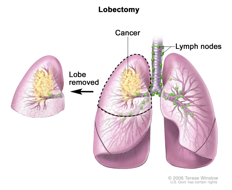 Lobectomy; drawing shows lobes of both lungs, trachea, bronchi, bronchioles, and lymph nodes. Cancer is shown in one lobe. The removed lobe is shown next to the lung from which it was removed.
