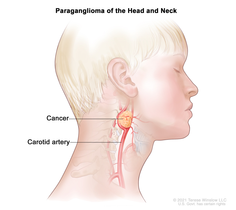 Paraganglioma of the head and neck; drawing shows a cancerous tumor near the carotid artery in the head and neck.