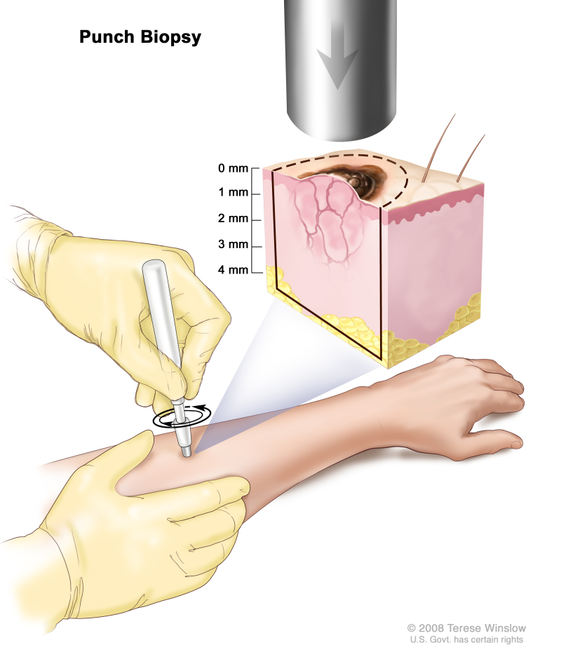 Punch biopsy; drawing shows a hollow, circular scalpel being inserted into a lesion on the skin of a patient’s forearm. The instrument is turned clockwise and counterclockwise to cut into the skin and a small sample of tissue is removed to be checked under a microscope. The pullout shows that the instrument cuts down about 4 millimeters (mm) to the layer of fatty tissue below the dermis.