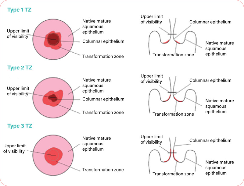 Figure. Transformation zone (TZ) types.