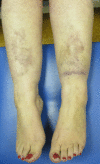 Figure 2. . Pretibial plaques have been described in 83% of individuals with periodontal EDS [Kapferer-Seebacher et al 2016].