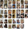 Figure 1. . Dysmorphic facial features of ANKRD17-related neurodevelopmental syndrome.