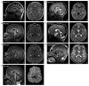 Figure 1. . Individuals with biallelic pathogenic ENTPD1 variants show white matter abnormalities, thinning of the corpus callosum, cerebellar atrophy, and signal abnormalities in the posterior limb of the internal capsule.