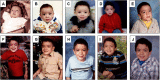 Figure 1. . Serial images of a male with mucopolysaccharidosis type VII at ages (A) 2.