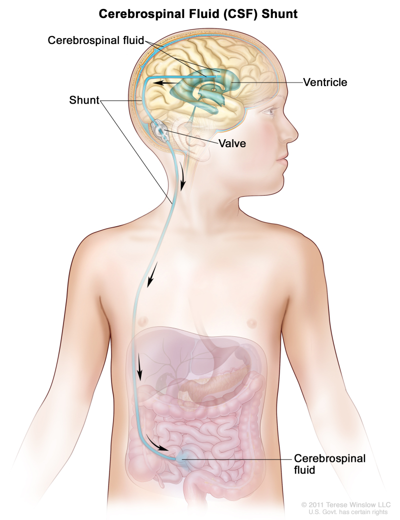 Drawing shows extra cerebrospinal fluid (CSF) flowing through a shunt (a long, thin tube) from a ventricle (fluid-filled space) in the brain into the abdomen. The shunt goes from the ventricle, under the skin in the neck and chest, and into the abdomen. Also shown is a shunt valve that controls the flow of CSF.