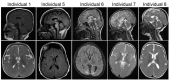 Figure 1. . T1- and T2-weighted brain MRI images of Individuals 1 and 5-8 in sagittal and axial planes.