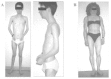 Figure 1. Clinical features of Emery-Dreifuss muscular dystrophy.