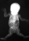 Figure 1. . A newborn with molecularly confirmed CHST3-related skeletal dysplasia.