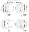 Figure 9. A predominance of hyperhaploidies over hypohaploidies and a greater proportion of unbalanced PSSC than of chromosome alterations has been observed, whereas a predominance of monosomies has been observed in studies of aneuploidies carried out in a wide series of embryos.