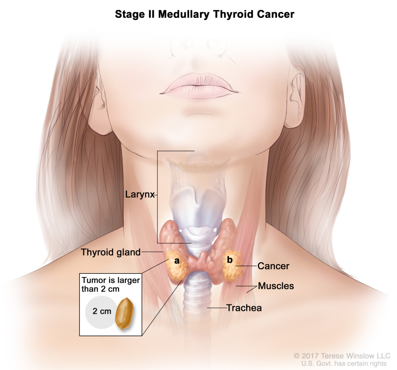 Stage II medullary thyroid cancer; drawing shows (a) cancer in the thyroid gland and the tumor is larger than 2 centimeters and (b) cancer has spread to nearby muscles in the neck. An inset shows 2 centimeters is about the size of a peanut. Also shown are the larynx and trachea.