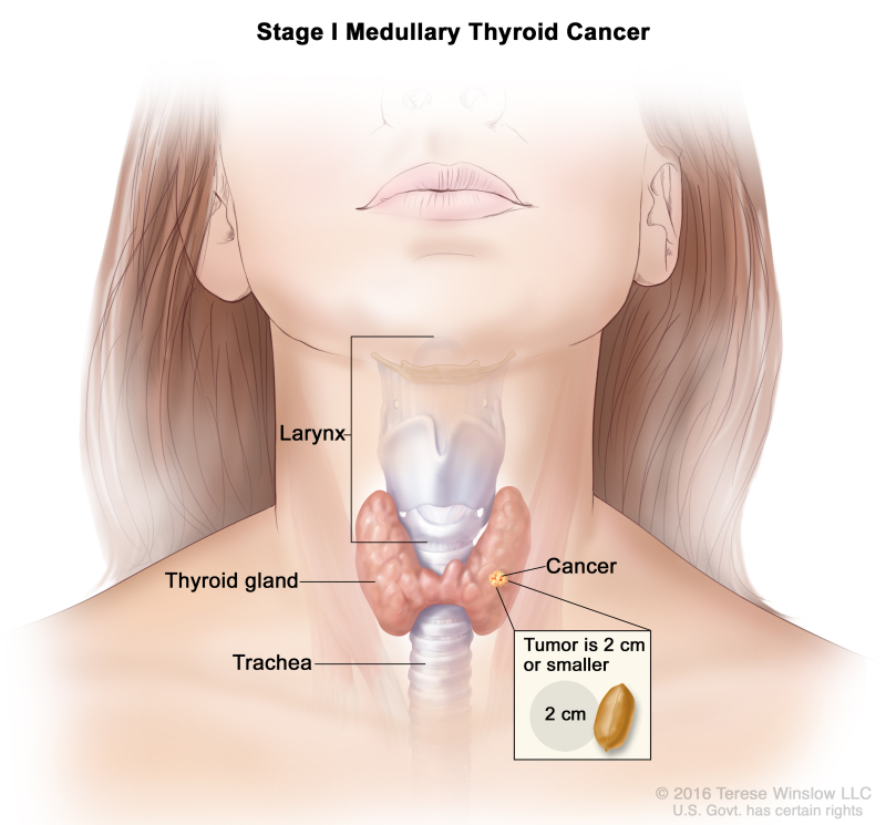 Stage I medullary thyroid cancer; drawing shows cancer in the thyroid gland and the tumor is 2 centimeters or smaller. An inset shows 2 centimeters is about the size of a peanut. Also shown are the larynx and trachea.