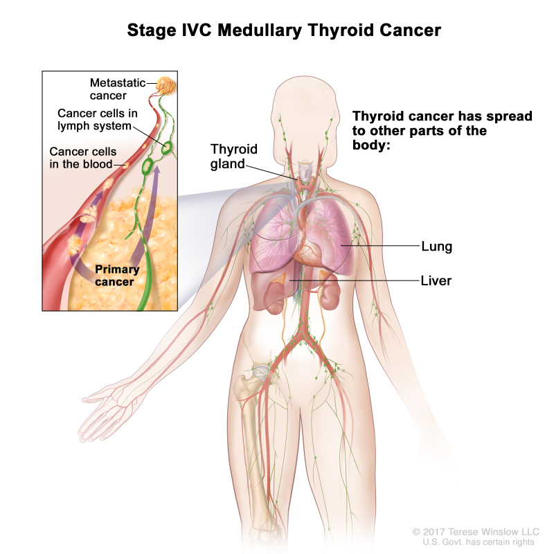 Stage IVC medullary thyroid cancer; drawing shows other parts of the body where thyroid cancer may spread, including the lung and liver. An inset shows cancer cells spreading from the thyroid, through the blood and lymph system, to another part of the body where metastatic cancer has formed.