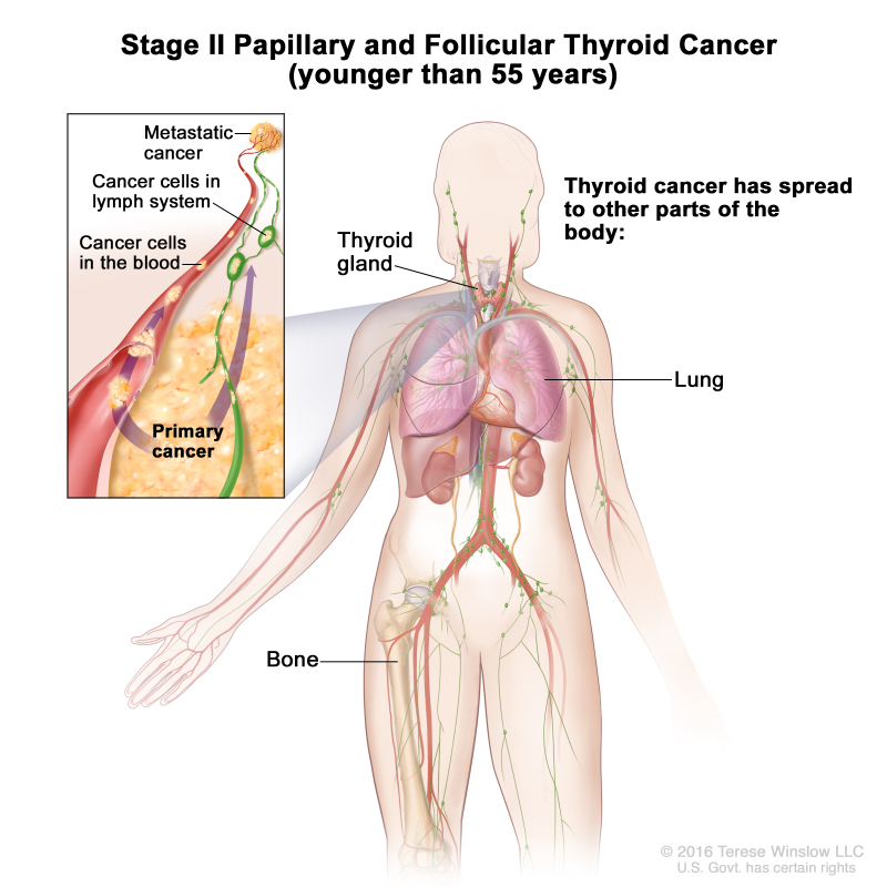 Stage II papillary and follicular thyroid cancer in patients younger than 55 years; drawing shows other parts of the body where thyroid cancer may spread, including the lung and bone. An inset shows cancer cells spreading from the thyroid gland, through the blood and lymph system, to another part of the body where metastatic cancer has formed.