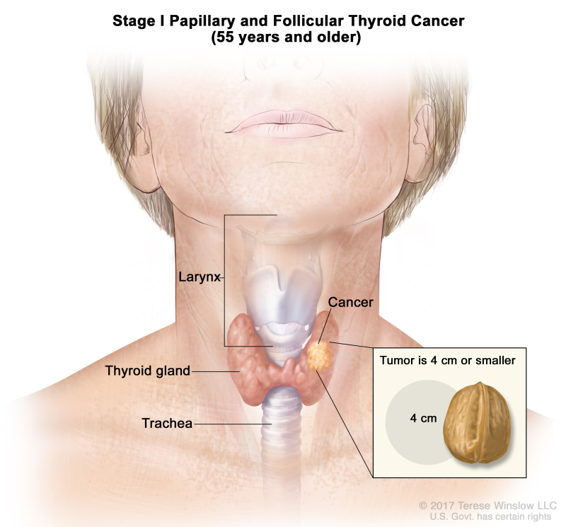 Stage I papillary and follicular thyroid cancer in patients 55 years and older; drawing shows cancer in the thyroid gland and the tumor is 4 centimeters or smaller. An inset shows 4 centimeters is about the size of a walnut. Also shown are the larynx and trachea.