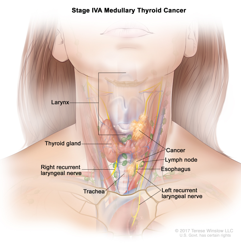 Stage IVA medullary thyroid cancer; drawing shows cancer in the thyroid gland and in the larynx, the esophagus, the left recurrent laryngeal nerve, the trachea, and a lymph node on one side of the neck. Also shown is the right recurrent laryngeal nerve.