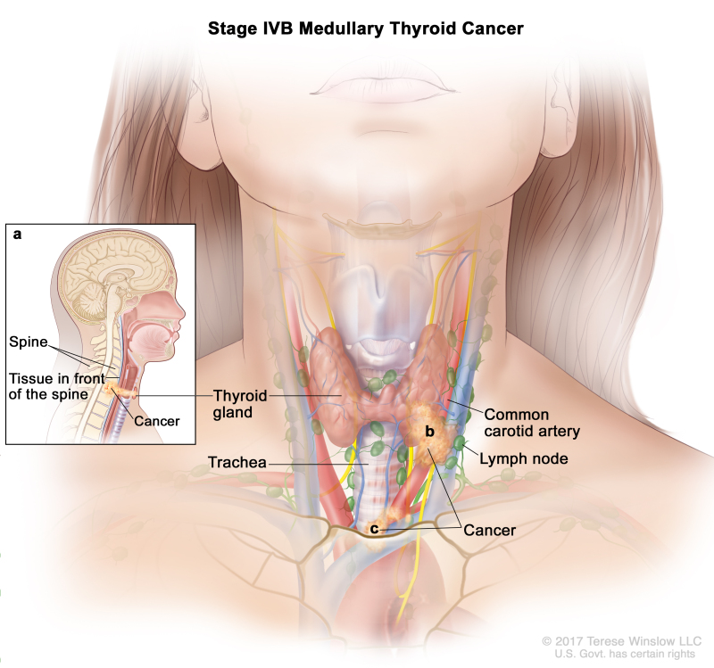 Stage IVB medullary thyroid cancer; drawing shows cancer has (a) spread from the thyroid gland to tissue in front of the spine and to the spine (inset), (b) surrounded the common carotid artery, and (c) surrounded the blood vessels in the area between the lungs. Also shown are the lymph nodes and trachea.